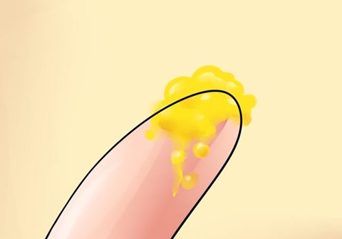 Mách bạn phân biệt dịch âm đạo bất thường - 9