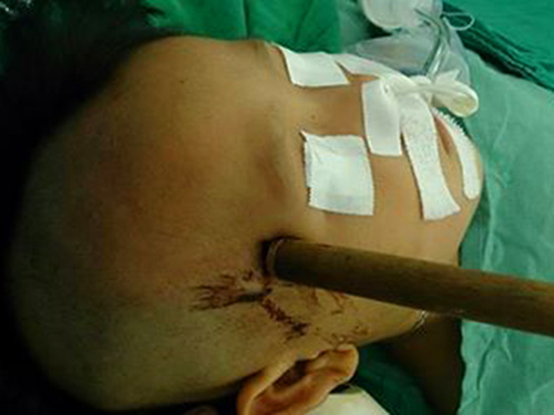 Dao đâm xuyên thấu não bé 3 tuổi - 1
