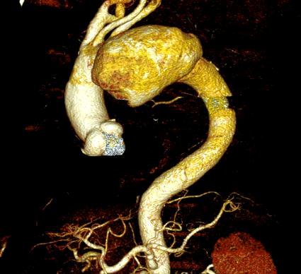 Ngưng tuần hoàn, tưới máu trực tiếp lên não để cứu sống bệnh nhân - 1