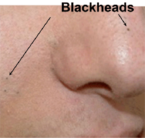 Mụn đầu đen, sợi bã nhờn: Cách phân biệt, xử lý, ngăn chặn - 4