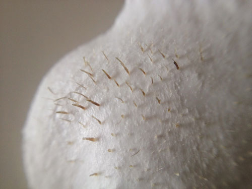 Mụn đầu đen, sợi bã nhờn: Cách phân biệt, xử lý, ngăn chặn - 2