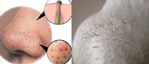 Mụn đầu đen, sợi bã nhờn: Cách phân biệt, xử lý, ngăn chặn - 1