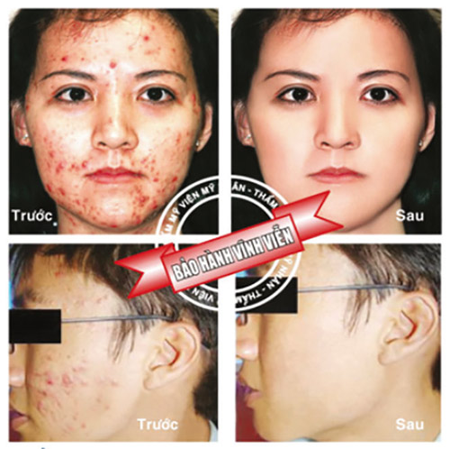 Điều trị mụn - thâm đột phá sau 3 ngày - 1