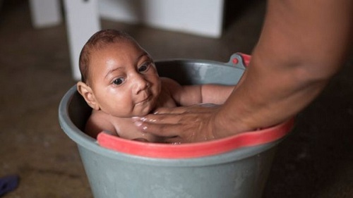 Giải đáp thắc mắc về mối liên quan giữa Zika và chứng đầu nhỏ - 1