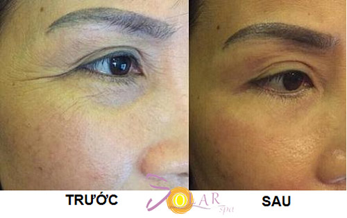 Căng da mặt 1 lần duy nhất không phẫu thuật - 5