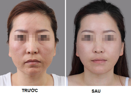 Căng da mặt 1 lần duy nhất không phẫu thuật - 2