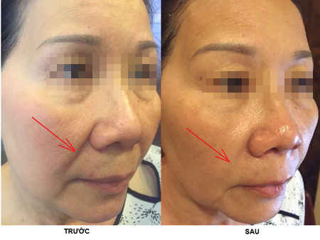 Căng da mặt 1 lần duy nhất không phẫu thuật - 3