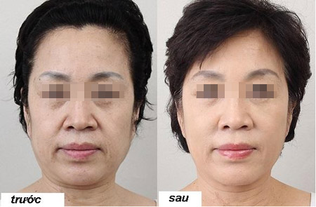 Căng da mặt 1 lần duy nhất không phẫu thuật - 4