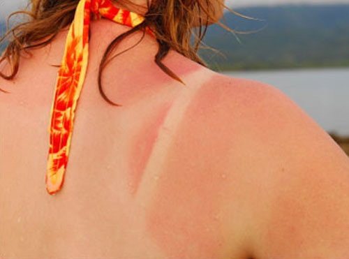 Chỉ số tia cực tím ở TP. HCM có thể gây ung thư da - 3