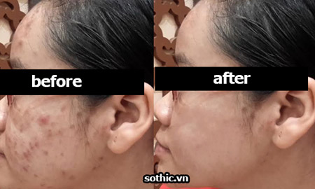 Trẻ hóa, trị sẹo với lăn kim và những câu hỏi thường gặp - 1