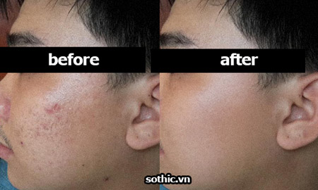 Trẻ hóa, trị sẹo với lăn kim và những câu hỏi thường gặp - 2