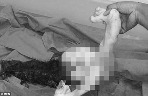 Kinh hoàng thai nhi nằm trong bụng chàng trai suốt 15 năm - 2