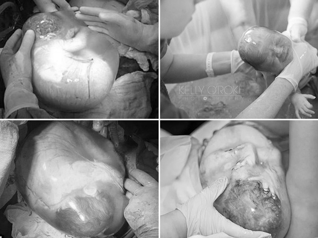 Ảnh hiếm 80 nghìn ca mới có một về bé chào đời trong bọc ối