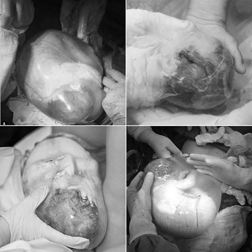 Ảnh hiếm 80 nghìn ca mới có một về bé chào đời trong bọc ối - 1