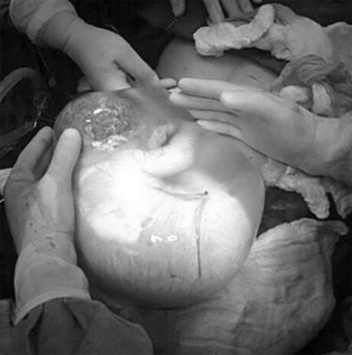 Ảnh hiếm 80 nghìn ca mới có một về bé chào đời trong bọc ối - 2