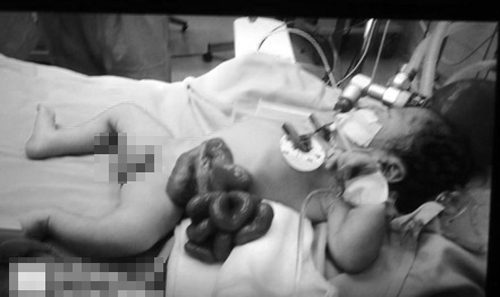 Xót lòng những em bé sơ sinh có nội tạng nằm ngoài cơ thể - 1