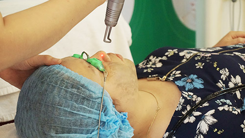 Giải mã sức nóng sau Ngày hội trị nám bằng laser ở Đông Á - 4