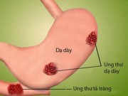 Sức khỏe - 6 dấu hiệu cảnh báo ung thư dạ dày không được bỏ qua