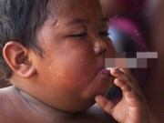 Nuôi con - Thân hình hiện tại của cậu bé 2 tuổi hút 40 điếu thuốc một ngày