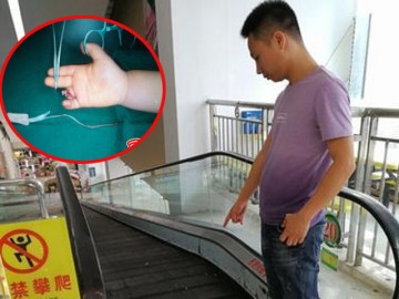 Tai nạn thang cuốn kinh hoàng, bé 1 tuổi bị kẹp đứt ngón tay