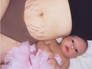 Bà bầu - Chẳng ngần ngại khoe vết rạn da tím đen, bà mẹ trẻ khiến nhiều người xấu hổ