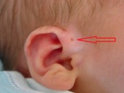Làm mẹ - Mẹ cứ ngỡ con có lỗ nhỏ ở vành tai là thông minh nhưng sự thật lại rất nguy hiểm