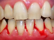 Sức khỏe - Chảy máu chân răng: Dấu hiệu cảnh báo bệnh ung thư