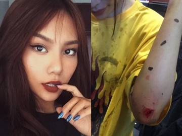 Quán quân The Voice - Vũ Thảo My bị ngã trầy xước vì gặp ô tô chạy ẩu