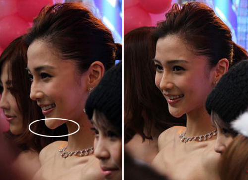 Angelababy lộ vết #039;cuồng#039; dao kéo - 3