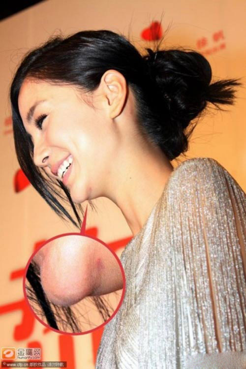 Angelababy lộ vết #039;cuồng#039; dao kéo - 4