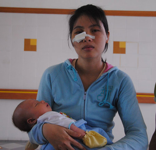 Một sản phụ bị côn đồ đánh vỡ hốc mắt - 1