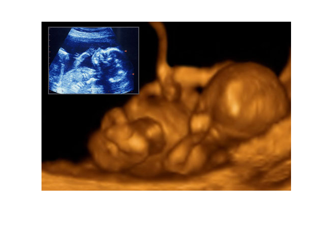 Thời gian siêu âm

Việc siêu âm thường được thực hiện cho tất cả các phụ nữ mang thai ở tuần thứ 20-22 của thai kỳ. Nhờ đó, các bác sĩ sẽ xác định được tình trạng khỏe mạnh và bình thường của nhau thai và đồng thời cũng kiểm tra xem bé có phát triển bình thường trong tử cung hay không. Nhịp tim và các chuyển động của cơ thể, cánh tay và chân cũng được nhìn thấy khi siêu âm.
