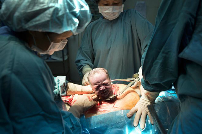 Sau khoảng hơn 30 phút một em bé đã chui được đầu ra ngoài tử cung.
