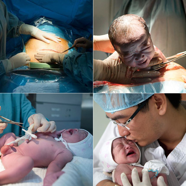Một ê kíp bác sĩ và phụ mổ gồm 5 người đã khéo léo tiến hành phẫu thuật thành công để đưa một em bé ra khỏi bụng mẹ trong thời gian 40 phút.
