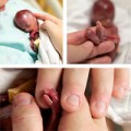 Làm mẹ - "Sốc" với độ tí hon của trẻ sinh non