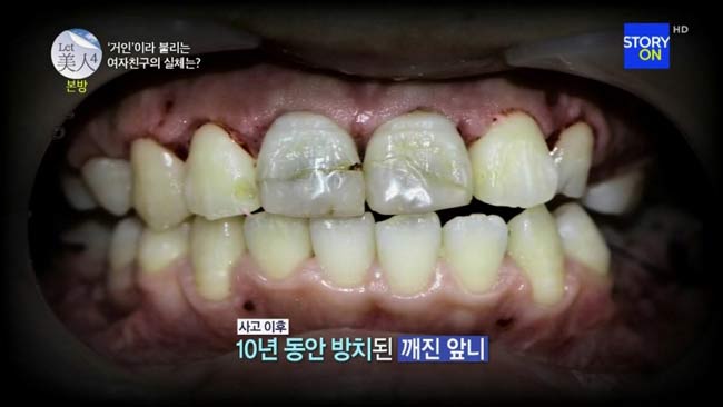 Hàm răng của cô gái này không chỉ nhô ra ngoài quá nhiều mà từng chiếc răng cũng có vấn đề như vỡ, mẻ và nhiều cao răng.
