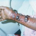 Tin tức - Dịch Ebola: Hà Nội yêu cầu dập tắt từ ca đầu tiên