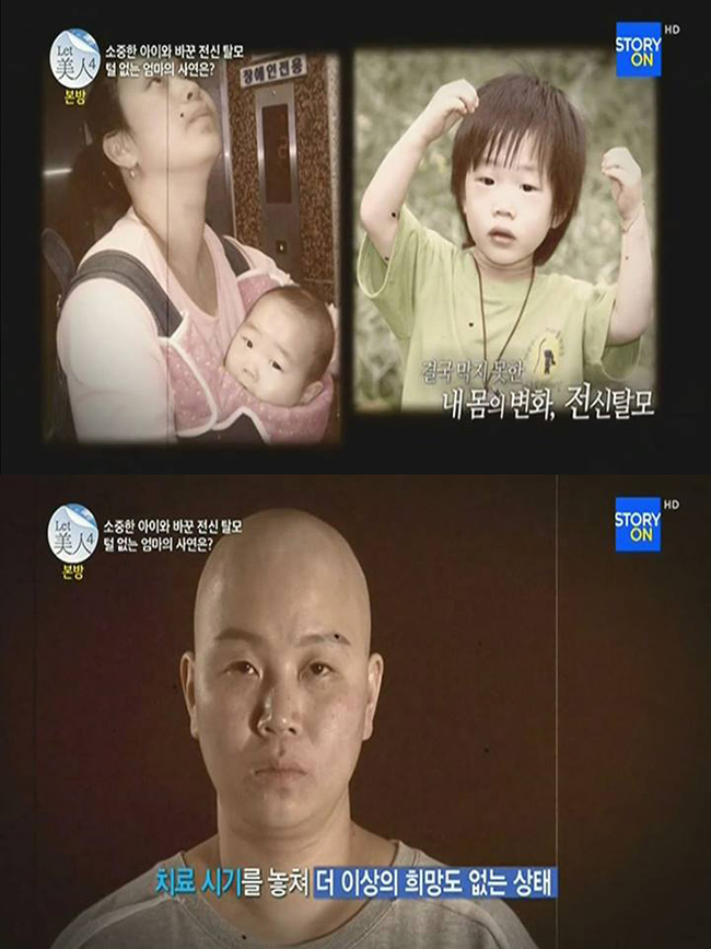 Kim Hyun Soo hiện tại có mái đầu trọc, không một sợi tóc do ảnh hưởng của việc sinh con lần thứ hai.
