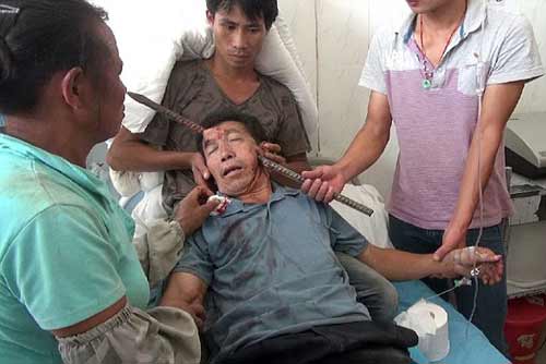 Thanh sắt xuyên thủng đầu vẫn sống sót thần kỳ - 1