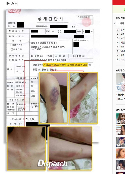 Lộ ảnh thương tích đầy mình của bạn gái Kim Hyun Joong - 2