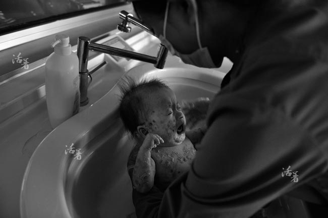 Công việc tắm cho Thiên thần nhỏ vô cùng khó khăn. Vì cơ thể không lành được các vết thương trên da, mụn nước lại thường xuyên vỡ nên khi tắm sẽ rất xót, gây đau đớn cho cậu bé.

