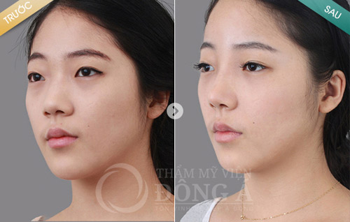 Các mẹ “mê mẩn” với bí quyết nâng mũi cao đẹp - 4