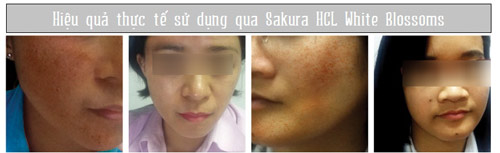 Phương thức trị nám hiện đại được lòng chị em - 2