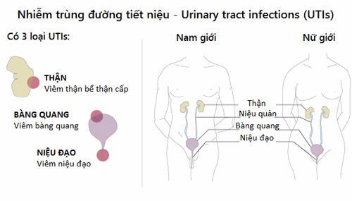 Những điều nên biết về bệnh nhiễm trùng đường tiết niệu - 1