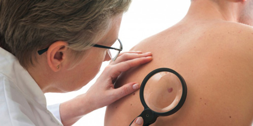 Các dấu hiệu nhận biết và những hiểm họa đáng sợ từ ung thư da - 2