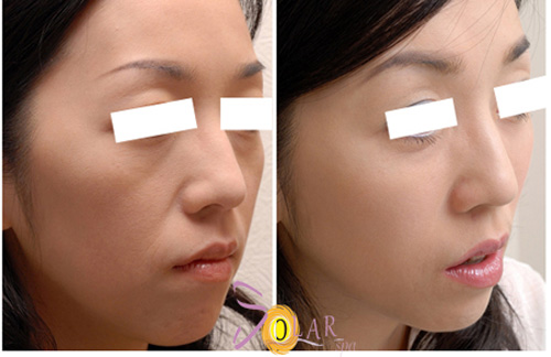Ưu đãi 70% nâng cơ, trẻ hóa công nghệ Thermage phiên bản mới - 2