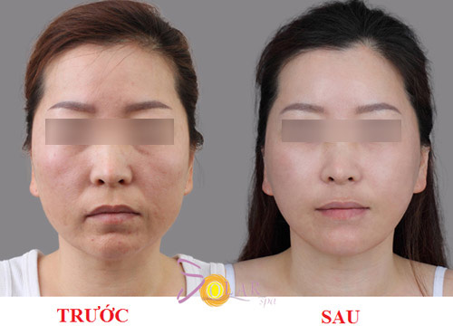 Ưu đãi 70% nâng cơ, trẻ hóa công nghệ Thermage phiên bản mới - 3