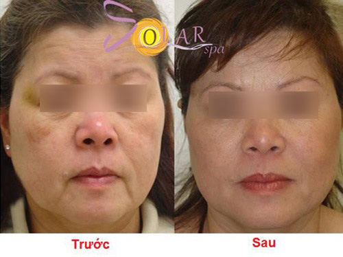 Ưu đãi 70% nâng cơ, trẻ hóa công nghệ Thermage phiên bản mới - 4