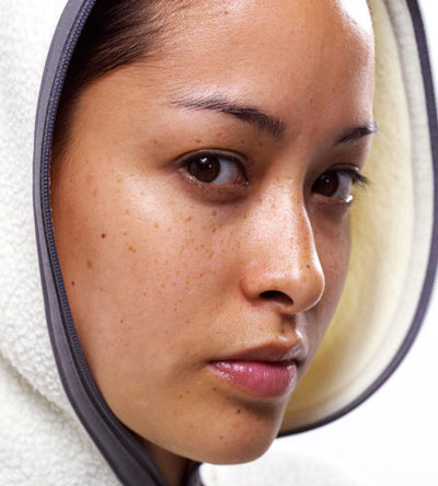 Trị nám sâu phải trị “tận gốc” - 1