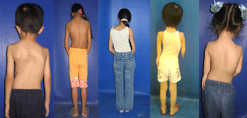 Cảnh báo nguy cơ học sinh mắc bệnh cong vẹo cột sống - 2